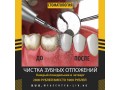 cistka-zubnyx-otlozenii-za-2800-rublei-small-0