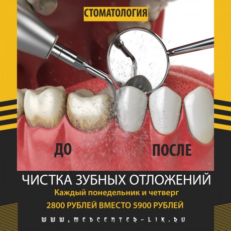 cistka-zubnyx-otlozenii-za-2800-rublei-big-0
